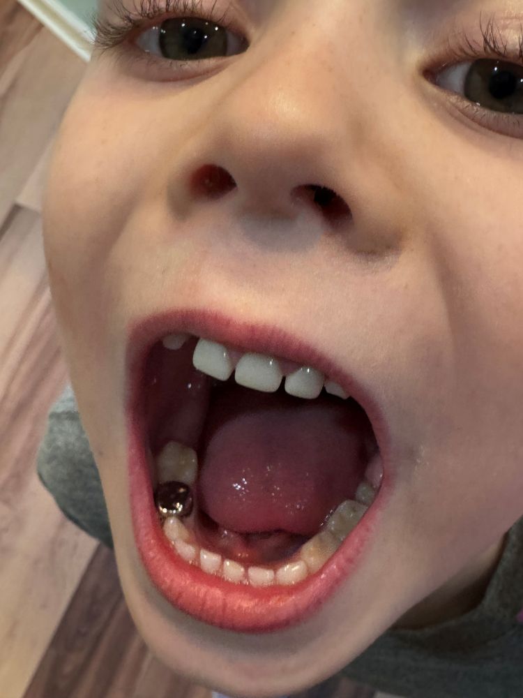 Hall crowns patient photo 1